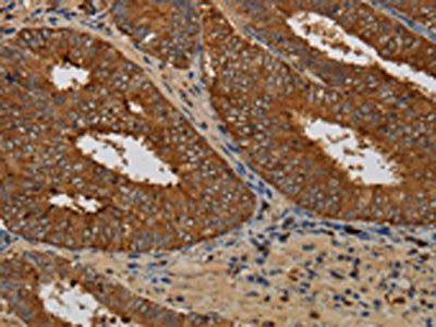 The image on the left is immunohistochemistry of paraffin-embedded Human colon cancer tissue using CSB-PA972784(KCNK17 Antibody) at dilution 1/60, on the right is treated with fusion protein. (Original magnification: ×200)