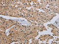 The image on the left is immunohistochemistry of paraffin-embedded Human prostate cancer tissue using CSB-PA972922(HSD3B7 Antibody) at dilution 1/40, on the right is treated with fusion protein. (Original magnification: ×200)