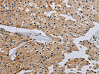The image on the left is immunohistochemistry of paraffin-embedded Human prostate cancer tissue using CSB-PA972922(HSD3B7 Antibody) at dilution 1/40, on the right is treated with fusion protein. (Original magnification: ×200)