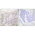 Immunohistochemistry analysis of paraffin-embedded human breast carcinoma tissue, using TNF receptor-1 antibody.