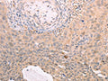 The image on the left is immunohistochemistry of paraffin-embedded Human cervical cancer tissue using CSB-PA973727(TXN Antibody) at dilution 1/30, on the right is treated with synthetic peptide. (Original magnification: ×200)
