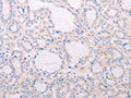 The image on the left is immunohistochemistry of paraffin-embedded Human thyroid cancer tissue using CSB-PA973863(TSHR Antibody) at dilution 1/50, on the right is treated with fusion protein. (Original magnification: ×200)