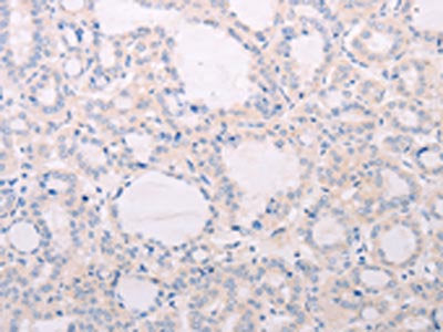 The image on the left is immunohistochemistry of paraffin-embedded Human thyroid cancer tissue using CSB-PA973863(TSHR Antibody) at dilution 1/50, on the right is treated with fusion protein. (Original magnification: ×200)