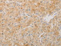 The image on the left is immunohistochemistry of paraffin-embedded Human liver cancer tissue using CSB-PA973928(AES Antibody) at dilution 1/20, on the right is treated with fusion protein. (Original magnification: ×200)