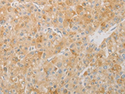 The image on the left is immunohistochemistry of paraffin-embedded Human liver cancer tissue using CSB-PA973928(AES Antibody) at dilution 1/20, on the right is treated with fusion protein. (Original magnification: ×200)