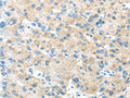 The image on the left is immunohistochemistry of paraffin-embedded Human liver cancer tissue using CSB-PA974102(ANGPTL5 Antibody) at dilution 1/25, on the right is treated with synthetic peptide. (Original magnification: ×200)