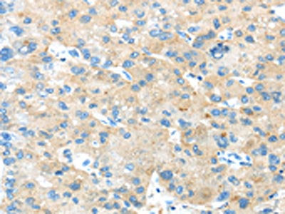 The image on the left is immunohistochemistry of paraffin-embedded Human liver cancer tissue using CSB-PA974102(ANGPTL5 Antibody) at dilution 1/25, on the right is treated with synthetic peptide. (Original magnification: ×200)