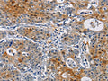 The image on the left is immunohistochemistry of paraffin-embedded Human gastic cancer tissue using CSB-PA974108(GSTA2 Antibody) at dilution 1/50, on the right is treated with fusion protein. (Original magnification: ×200)