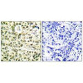Immunohistochemical analysis of paraffin-embedded human breast carcinoma tissue using PCNA antibody.