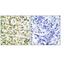 Immunohistochemical analysis of paraffin-embedded human breast carcinoma tissue using PCNA antibody.