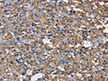 The image on the left is immunohistochemistry of paraffin-embedded Human thyroid cancer tissue using CSB-PA974344(CD160 Antibody) at dilution 1/60, on the right is treated with fusion protein. (Original magnification: ×200)