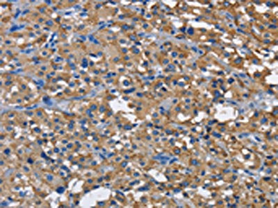 The image on the left is immunohistochemistry of paraffin-embedded Human thyroid cancer tissue using CSB-PA974344(CD160 Antibody) at dilution 1/60, on the right is treated with fusion protein. (Original magnification: ×200)