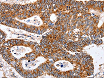 The image on the left is immunohistochemistry of paraffin-embedded Human colon cancer tissue using CSB-PA975112(MAP2K5 Antibody) at dilution 1/40, on the right is treated with fusion protein. (Original magnification: ×200)
