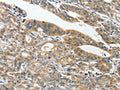 The image on the left is immunohistochemistry of paraffin-embedded Human gastic cancer tissue using CSB-PA975279(ANKZF1 Antibody) at dilution 1/40, on the right is treated with synthetic peptide. (Original magnification: ×200)
