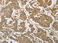 The image on the left is immunohistochemistry of paraffin-embedded Human colon cancer tissue using CSB-PA975347(EIF3F Antibody) at dilution 1/30, on the right is treated with fusion protein. (Original magnification: ×200)