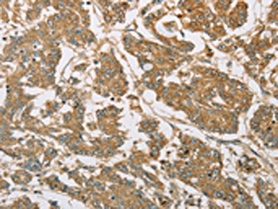 The image on the left is immunohistochemistry of paraffin-embedded Human colon cancer tissue using CSB-PA975347(EIF3F Antibody) at dilution 1/30, on the right is treated with fusion protein. (Original magnification: ×200)