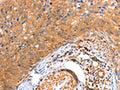 The image on the left is immunohistochemistry of paraffin-embedded Human cervical cancer tissue using CSB-PA975419(ACOX3 Antibody) at dilution 1/35, on the right is treated with fusion protein. (Original magnification: ×200)