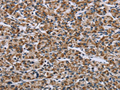 The image on the left is immunohistochemistry of paraffin-embedded Human prostate cancer tissue using CSB-PA975479(GTPBP10 Antibody) at dilution 1/60, on the right is treated with fusion protein. (Original magnification: ×200)