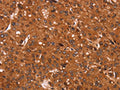 The image on the left is immunohistochemistry of paraffin-embedded Human liver cancer tissue using CSB-PA975999(CCND3 Antibody) at dilution 1/40, on the right is treated with synthetic peptide. (Original magnification: ×200)