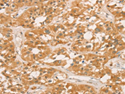 The image on the left is immunohistochemistry of paraffin-embedded Human thyroid cancer tissue using CSB-PA976017(CPB1 Antibody) at dilution 1/60, on the right is treated with fusion protein. (Original magnification: ×200)