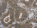 The image on the left is immunohistochemistry of paraffin-embedded Human colon cancer tissue using CSB-PA976299(HSD3B1 Antibody) at dilution 1/40, on the right is treated with fusion protein. (Original magnification: ×200)