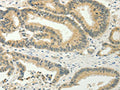 The image on the left is immunohistochemistry of paraffin-embedded Human colon cancer  tissue using CSB-PA976302(SPIN4 Antibody) at dilution 1/20, on the right is treated with fusion protein. (Original magnification: ×200)