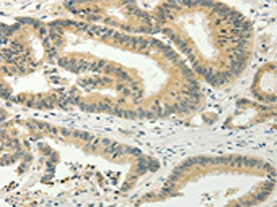 The image on the left is immunohistochemistry of paraffin-embedded Human colon cancer  tissue using CSB-PA976302(SPIN4 Antibody) at dilution 1/20, on the right is treated with fusion protein. (Original magnification: ×200)