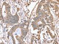 The image on the left is immunohistochemistry of paraffin-embedded Human colon cancer tissue using CSB-PA976738(ABCB6 Antibody) at dilution 1/15, on the right is treated with fusion protein. (Original magnification: ×200)