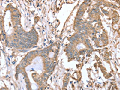 The image on the left is immunohistochemistry of paraffin-embedded Human colon cancer tissue using CSB-PA976738(ABCB6 Antibody) at dilution 1/15, on the right is treated with fusion protein. (Original magnification: ×200)