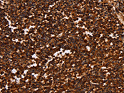 The image on the left is immunohistochemistry of paraffin-embedded Human tonsil tissue using CSB-PA976819(ALG11 Antibody) at dilution 1/40, on the right is treated with synthetic peptide. (Original magnification: ×200)