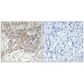 Immunohistochemistry analysis of paraffin-embedded human liver carcinoma tissue using GCNT3 antibody.
