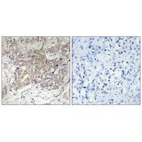 Immunohistochemistry analysis of paraffin-embedded human liver carcinoma tissue using GCNT3 antibody.
