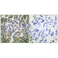 Immunohistochemical analysis of paraffin-embedded human breast carcinoma tissue using HSP10 antibody.
