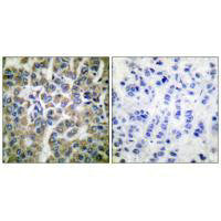 Immunohistochemical analysis of paraffin-embedded human breast carcinoma tissue using HSP10 antibody.