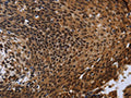 The image is immunohistochemistry of paraffin-embedded Human cervical cancer using CSB-PA977533(FHL3 Antibody) at dilution 1/40. (Original magnification: ×200)