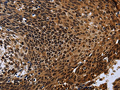The image is immunohistochemistry of paraffin-embedded Human cervical cancer using CSB-PA977533(FHL3 Antibody) at dilution 1/40. (Original magnification: ×200)