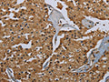 The image on the left is immunohistochemistry of paraffin-embedded Human prostate cancer tissue using CSB-PA977537(GBP5 Antibody) at dilution 1/40, on the right is treated with fusion protein. (Original magnification: ×200)