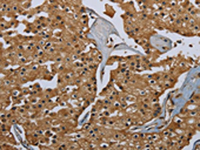 The image on the left is immunohistochemistry of paraffin-embedded Human prostate cancer tissue using CSB-PA977537(GBP5 Antibody) at dilution 1/40, on the right is treated with fusion protein. (Original magnification: ×200)