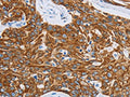 The image on the left is immunohistochemistry of paraffin-embedded Human esophagus cancer tissue using CSB-PA978241(MMP21 Antibody) at dilution 1/15, on the right is treated with synthetic peptide. (Original magnification: ×200)