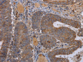 The image on the left is immunohistochemistry of paraffin-embedded Human colon cancer tissue using CSB-PA978301(FADS1 Antibody) at dilution 1/50, on the right is treated with fusion protein. (Original magnification: ×200)