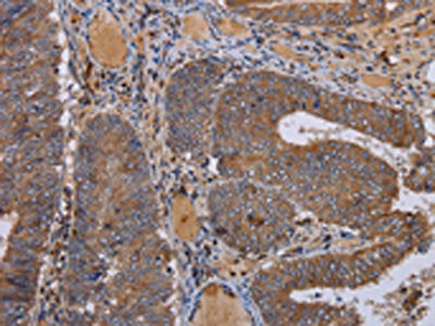 The image on the left is immunohistochemistry of paraffin-embedded Human colon cancer tissue using CSB-PA978301(FADS1 Antibody) at dilution 1/50, on the right is treated with fusion protein. (Original magnification: ×200)