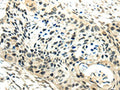 The image on the left is immunohistochemistry of paraffin-embedded Human esophagus cancer tissue using CSB-PA978337(SYNCRIP Antibody) at dilution 1/30, on the right is treated with synthetic peptide. (Original magnification: ×200)