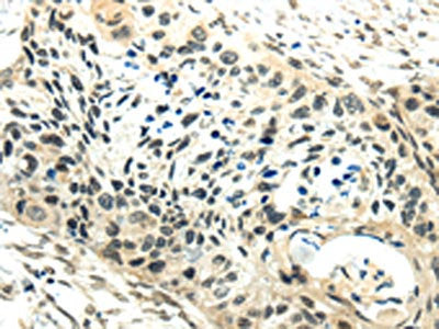 The image on the left is immunohistochemistry of paraffin-embedded Human esophagus cancer tissue using CSB-PA978337(SYNCRIP Antibody) at dilution 1/30, on the right is treated with synthetic peptide. (Original magnification: ×200)