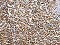 The image on the left is immunohistochemistry of paraffin-embedded Human tonsil tissue using CSB-PA978564(IRAK3 Antibody) at dilution 1/50, on the right is treated with fusion protein. (Original magnification: ×200)