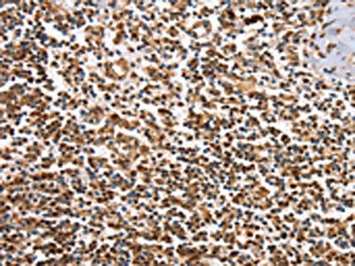 The image on the left is immunohistochemistry of paraffin-embedded Human tonsil tissue using CSB-PA978564(IRAK3 Antibody) at dilution 1/50, on the right is treated with fusion protein. (Original magnification: ×200)