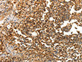 The image on the left is immunohistochemistry of paraffin-embedded Human tonsil tissue using CSB-PA978774(LRP12 Antibody) at dilution 1/25, on the right is treated with fusion protein. (Original magnification: ×200)