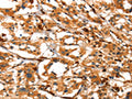 The image on the left is immunohistochemistry of paraffin-embedded Human thyroid cancer tissue using CSB-PA979441(ACTA2 Antibody) at dilution 1/40, on the right is treated with synthetic peptide. (Original magnification: ×200)