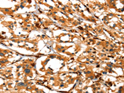 The image on the left is immunohistochemistry of paraffin-embedded Human thyroid cancer tissue using CSB-PA979441(ACTA2 Antibody) at dilution 1/40, on the right is treated with synthetic peptide. (Original magnification: ×200)