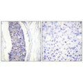 Immunohistochemistry analysis of paraffin-embedded human breast carcinoma tissue using Tubulin α antibody.