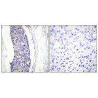 Immunohistochemistry analysis of paraffin-embedded human breast carcinoma tissue using Tubulin α antibody.